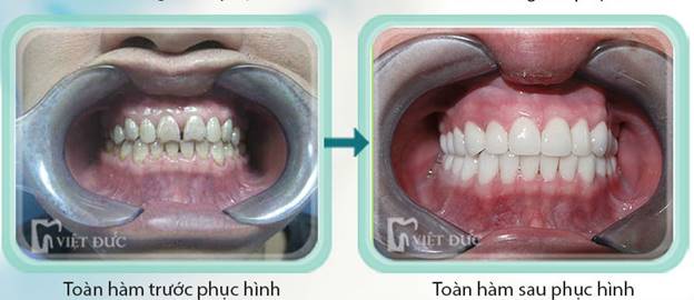 truoc-va-sau-khi-phuc-hinh