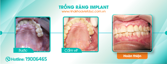 khach-hang-cay-implant2