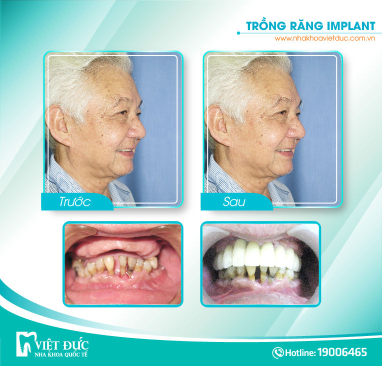 khach-hang-cay-implant3