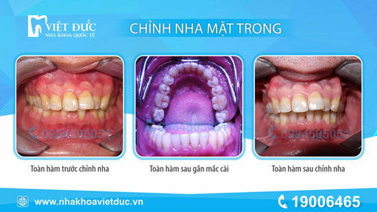 khach-nieng-rang-mat-trong