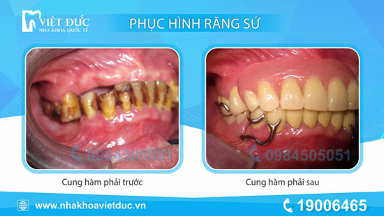khach-hang-phuc-hinh-thao-lap-1
