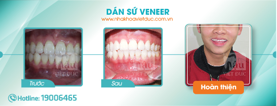 khach-hang-dan-su-veneer1