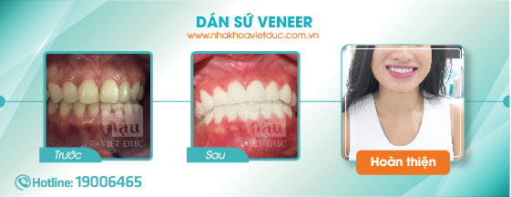 khach-hang-dan-su-veneer2
