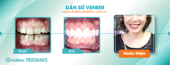 khach-hang-dan-su-veneer3