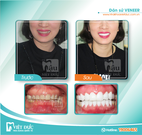 khach-hang-dan-su-veneer6