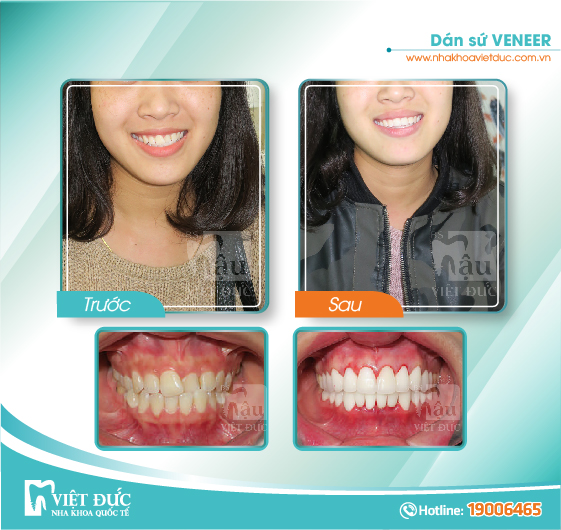 khach-hang-dan-su-veneer7