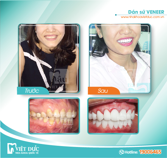 khach-hang-dan-su-veneer8