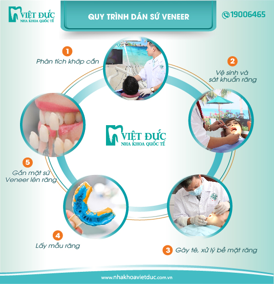 quy-trinh-dan-su-veneer