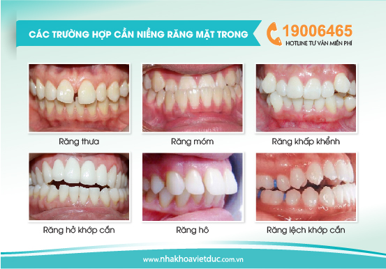 Niềng răng mặt trong phù khắc phục được hầu hết các sai lệch răng như: hô, móm, khấp khểnh…