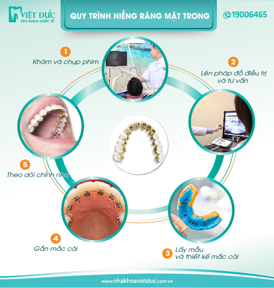 Quy trình niềng răng theo tiêu chuẩn Châu Âu