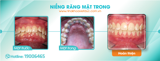 nieng-rang-mat-trong-tai-viet-duc