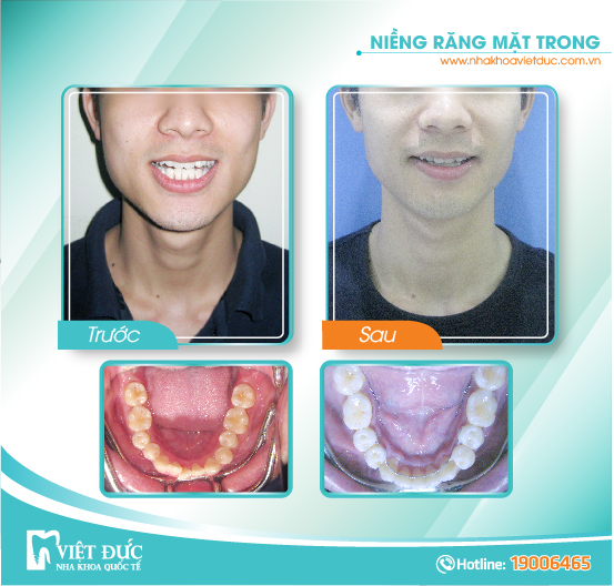 Nguyễn Văn Hiếu, 31 tuổi, Mễ Trì, khớp căn sâu, răng khấp khểnh, chỉnh nha mặt trong hàm dưới