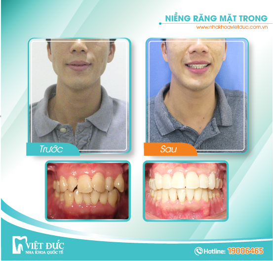 Ngô Văn Chiểu, 29 tuổi, Long Biên, răng hô, lệch lạc, sai khớp cắn, chỉnh nha mặt trong cả 2 hàm