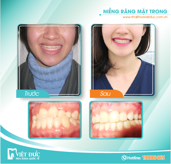 Vương Thị Ngọc, 35 tuổi, Hải Phòng, răng hô, chỉnh nha mặt trong cả 2 hàm.