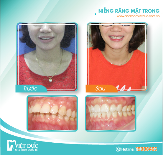 Nguyễn Vân Anh, 25 tuổi, Bắc Giang, khớp căn ngược, chỉnh nha mặt trong cả 2 hàm.
