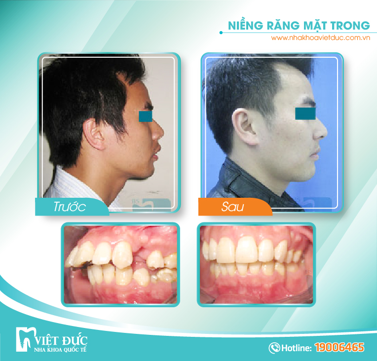 Vũ Quang Huy, 32 tuổi, Hưng Yên, răng hô, khấp khểnh chen chúc, chỉnh nha mặt lưỡi hàm trên
