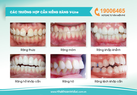 Niềng răng Vline phù hợp với hầu hết các trường hợp răng sai lệch, hô, móm, khấp khểnh…