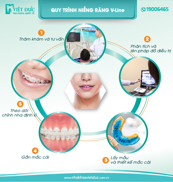 Quy trình niềng răng Vline tại nha khoa Quốc tế Việt Đức