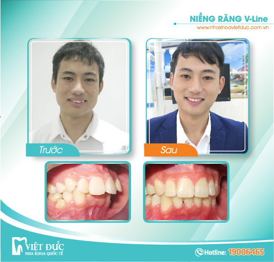 Nguyễn Văn Vịnh, 28 tuổi, Bắc Giang, hô hàm, răng khấp khểnh, niềng răng Vline cả hai hàm.