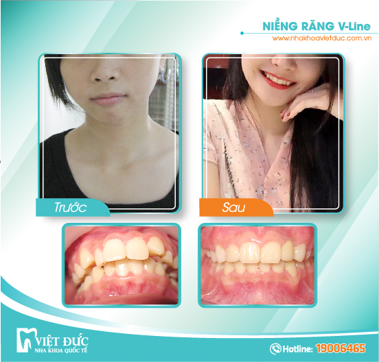 Bùi Khánh Huyền, 24 tuổi, Hà Nội, hô hàm, khấp khểnh, niềng răng Vline vả hai hàm