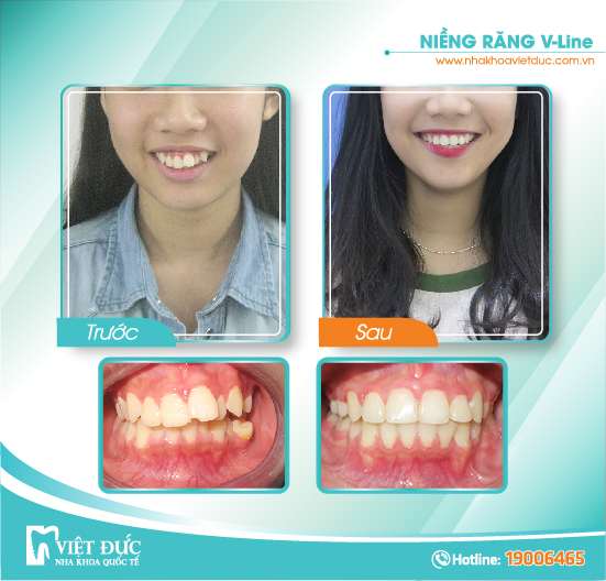 Nguyễn Thị Ngọc Mai, 20 tuổi, Hải Phòng, hô răng, khớp cắn lệch, niềng răng Vline cả hai hàm
