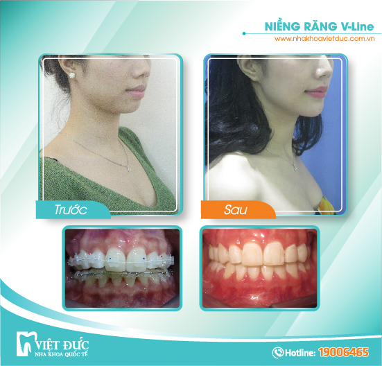 Vũ Trà My, 25 tuổi, Yên Bái, khớp cắn sâu, niềng răng Vline cả 2 hàm