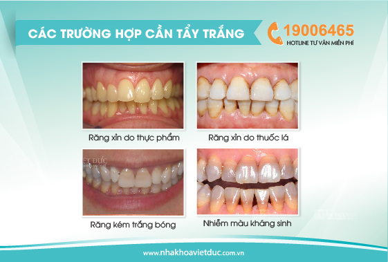 cac-truong-hop-tay-trang-rang