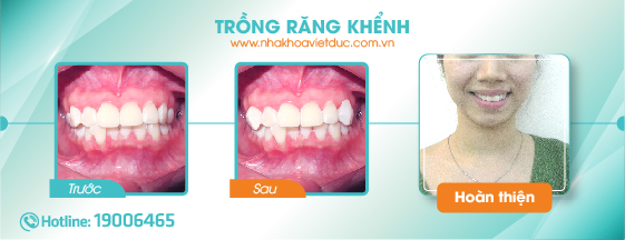 khach-hang-tram-rang-khenh1