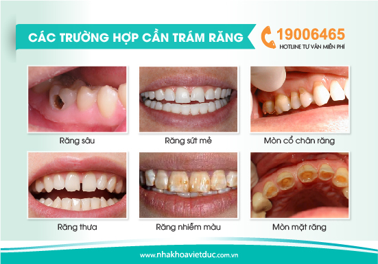 cac-truong-hop-tram-rang