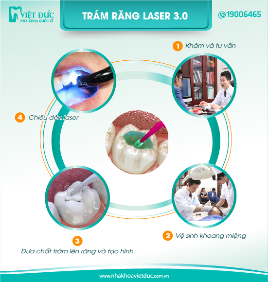 quy-trinh-tram-rang