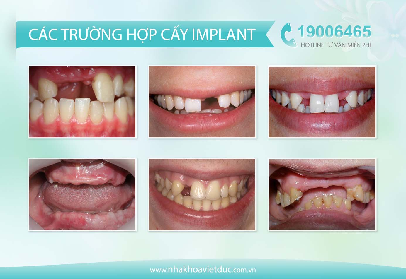 truong-hop-cay-implant