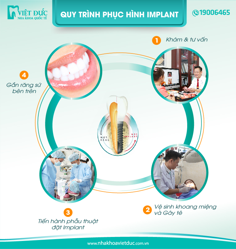 quy-trinh-cay-ghep-implant