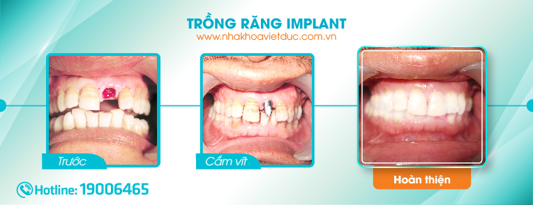 truoc-va-sau-khi-trong-rang-implant