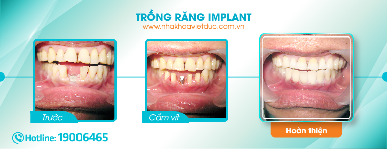 sau-khi-cay-ghep-implant
