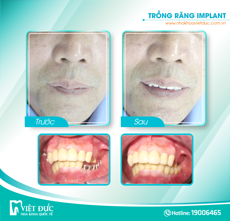 hinh-anh-benh-nhan-cay-ghep-implant