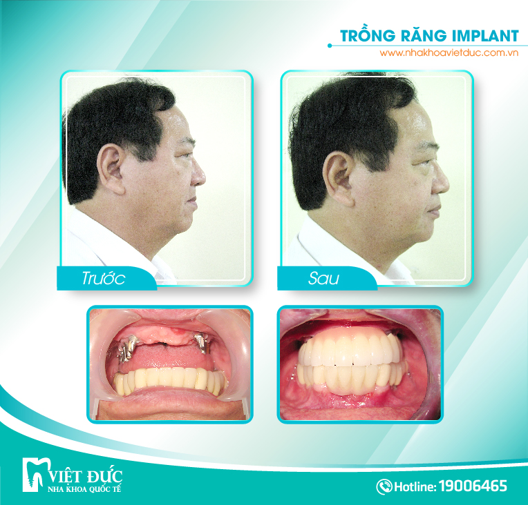 khach-hang-trong-implant