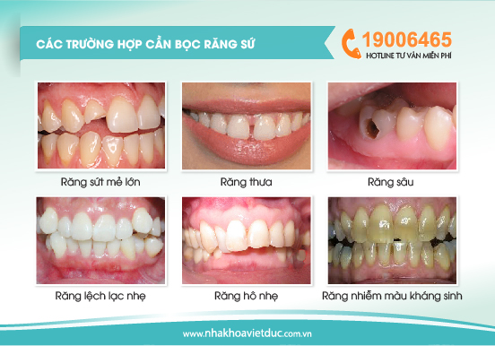 cac-truong-hop-boc-rang-su