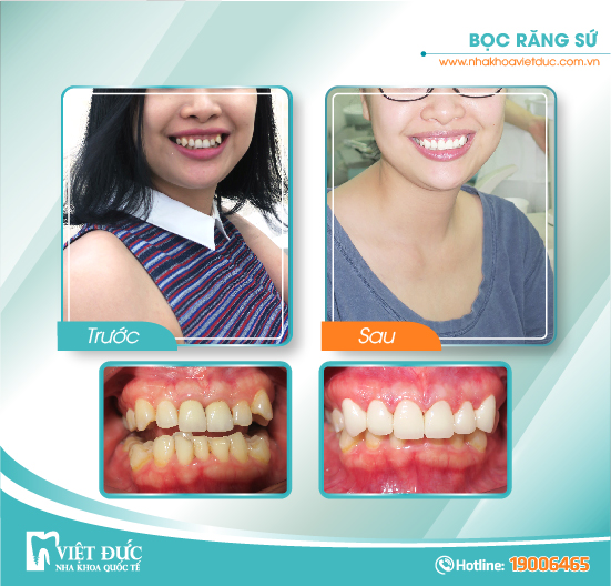 khach-hang-boc-rang-su10