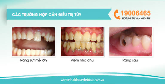 cac-truong-hop-can-dieu-tri-tuy
