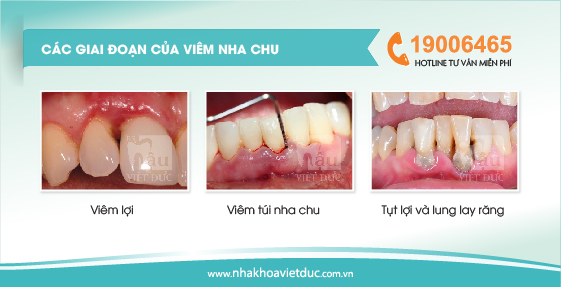 cac-truong-hop-viem-nha-chu