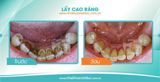 khach-hang-lay-cao-rang2