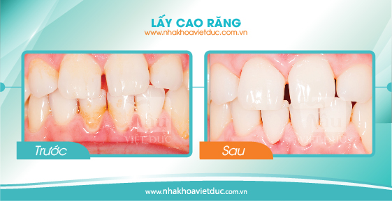 khach-hang-lay-cao-rang4