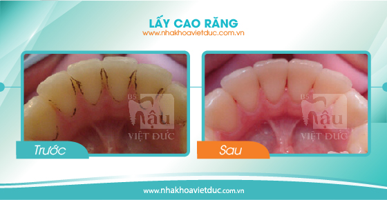 khach-hang-lay-cao-rang5