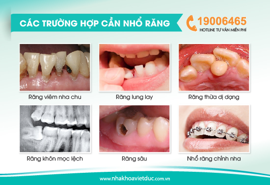 truong-hop-can-nho-rang