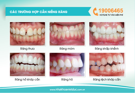 cac-truong-hop-nieng-rang